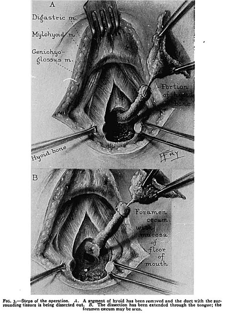 La cirugía para la resección de quiste tirogloso fue descrita por el Dr. Walter Sistrunk en 1920. 
A más de 100 años de haberse descrito, sigue vigente con tasas de recurrencia <3% 😮👶🏻.
Aquí una de sus ilustraciones originales 👇🏻#some4pedsurg
