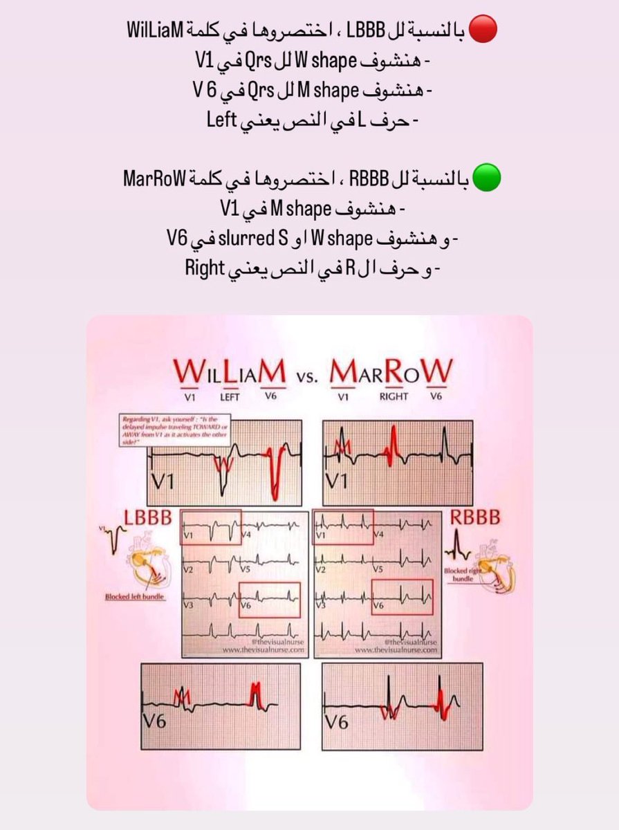 من الحاجات الرخمة في ال ECG هو انك تفرق بين :
RBBB و LBBB

ف دي طريقة بسيطة نقدر نفرق بينهم

عينينا تكون على Qrs في V1 و V6 ⬇️