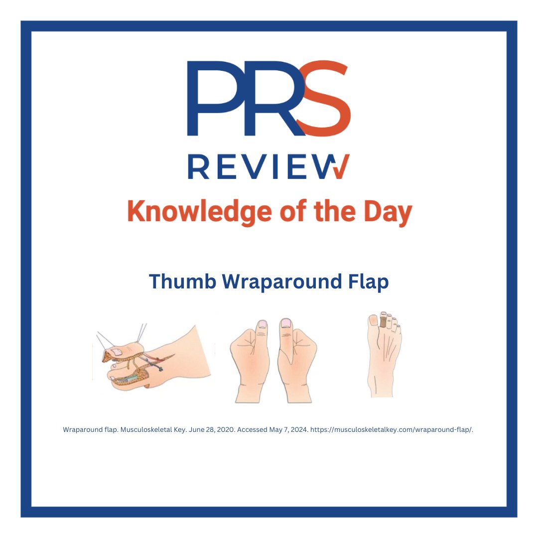 Thumb wraparound flap

#prsreview #thumbreconstruction #thumbinjury #handsurgery #wraparoundflap #flapsurgery #handsurgery #orthopedicsurgery #microsurgery #plasticsurgery #reconstructivesurgery #surgicaleducation #medicaleducation #meded #plasticsurgeon #surgery