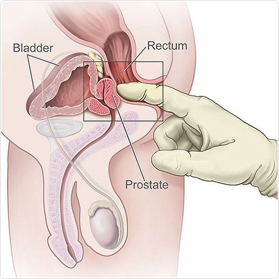𝗔𝘁 𝘄𝗵𝗮𝘁 𝗮𝗴𝗲 𝘀𝗵𝗼𝘂𝗹𝗱 𝗺𝗲𝗻 𝗴𝗲𝘁 𝗮 𝗽𝗿𝗼𝘀𝘁𝗮𝘁𝗲 𝗲𝘅𝗮𝗺? A prostate screening can help your doctor find prostate cancer early, but you’ll need to decide if the benefits of the exam outweigh the risks. Have a discussion with your doctor about prostate cancer…