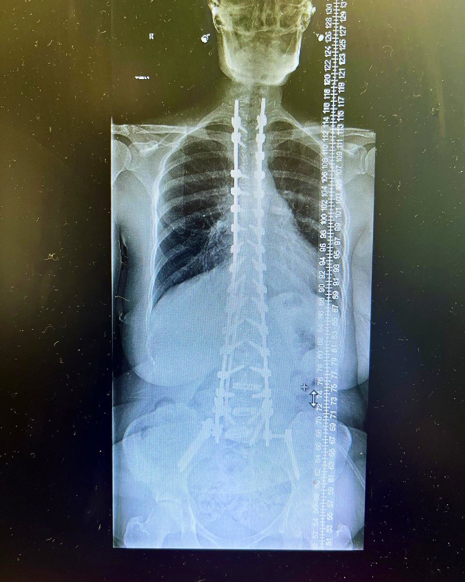 Straightening out spines with a solid team and advanced techniques, reinforced by titanium. Restoring balance, one back at a time

#neurosurgery #spinesurgery #spine