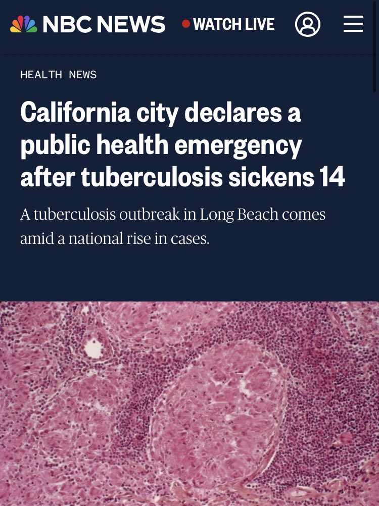 “Tuberculosis cases have increased in the U.S. since 2020 after 27 years of decline” Oh super weird what could have possibly happened in 2020 that we’re pretending ended that year too…?