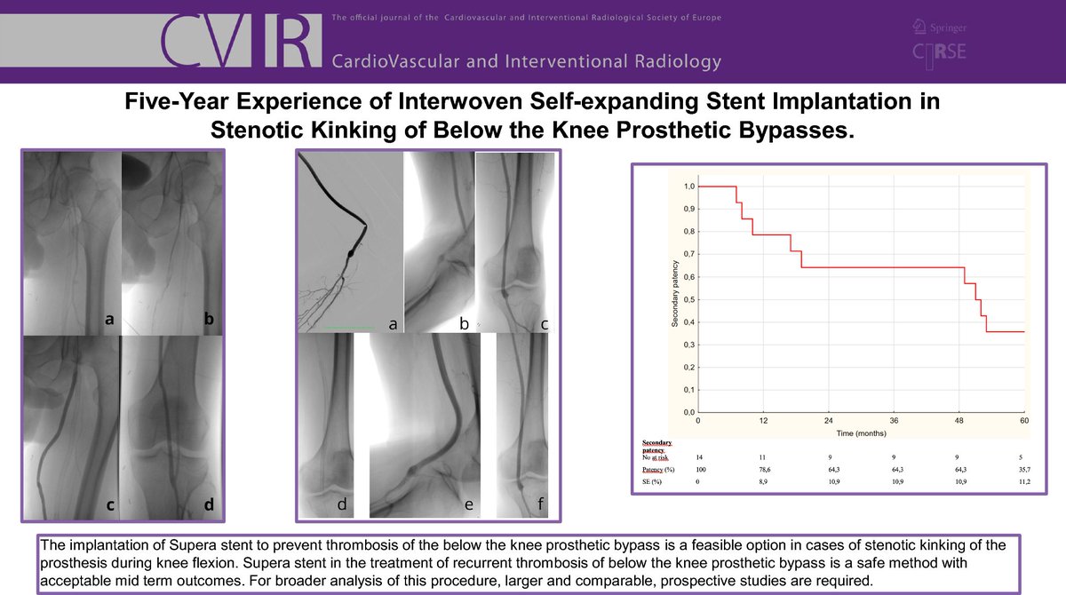 Read now in CVIR 📖 Five-Year Experience of Interwoven Self-Expanding Stent Implantation in Stenotic Kinking of Below the Knee Prosthetic Bypasses bit.ly/3WnO7Yn
