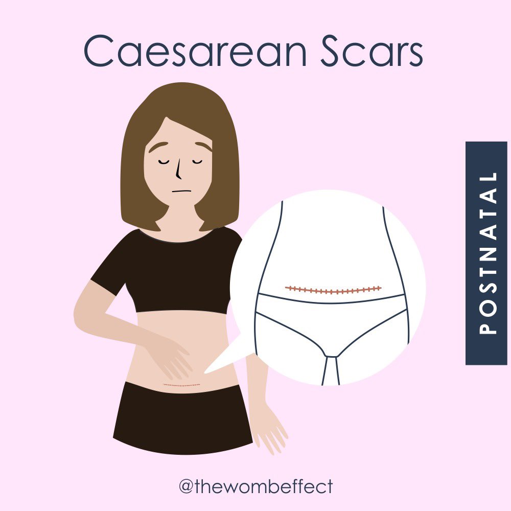 CAESAREAN SCARS ✂️🔸A #Caesarean section #scar is the mark left behind after a caesarean delivery, usually between 10-15cm just above the bikini hairline #thewombeffect #postnatal More 👉 instagram.com/p/C6al9PhMQC-/…
