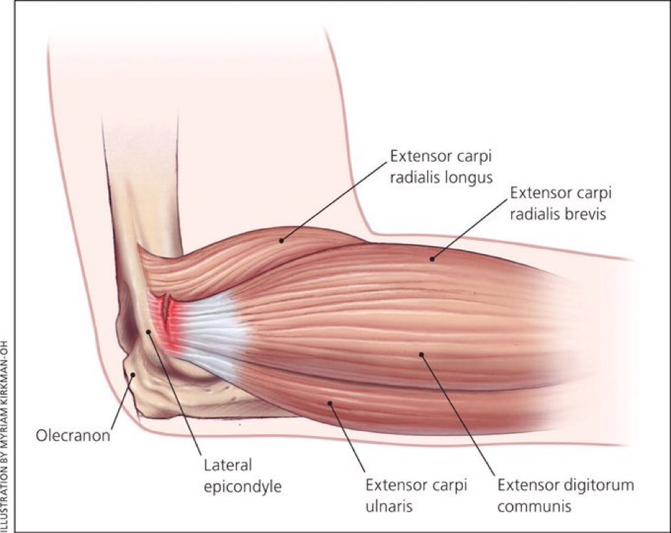 Tennis Elbow ▶️Overuse tendinopathy ▶️Annual incidence 👉🏾1%-3% ▶️Most patients in 30s & 40s ▶️maximal tenderness ~1cm distal to epicondyle at origin of extensor carpi radialis brevis ▶️Pain & ⤵️strength with resisted gripping, wrist supination/extension aafp.org/pubs/afp/issue…