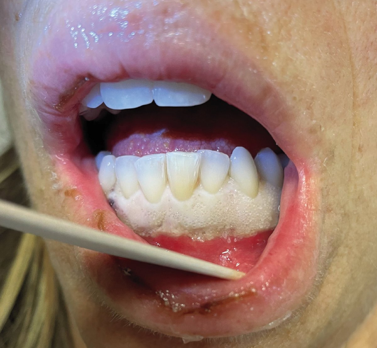 ManualOMedicine's tweet photo. A 48 y/o woman with a 1-week history of fatigue and painful, swollen gums. On examination, she was febrile and tachycardic. A WBC count was 225,000 per mm3.
- What is the diagnosis?
β‘οΈ Answer and Full Case: https://t.co/ZoWtX6Suwt
#medtwitte #foamed #usmle https://t.co/LEkOdJaIHk