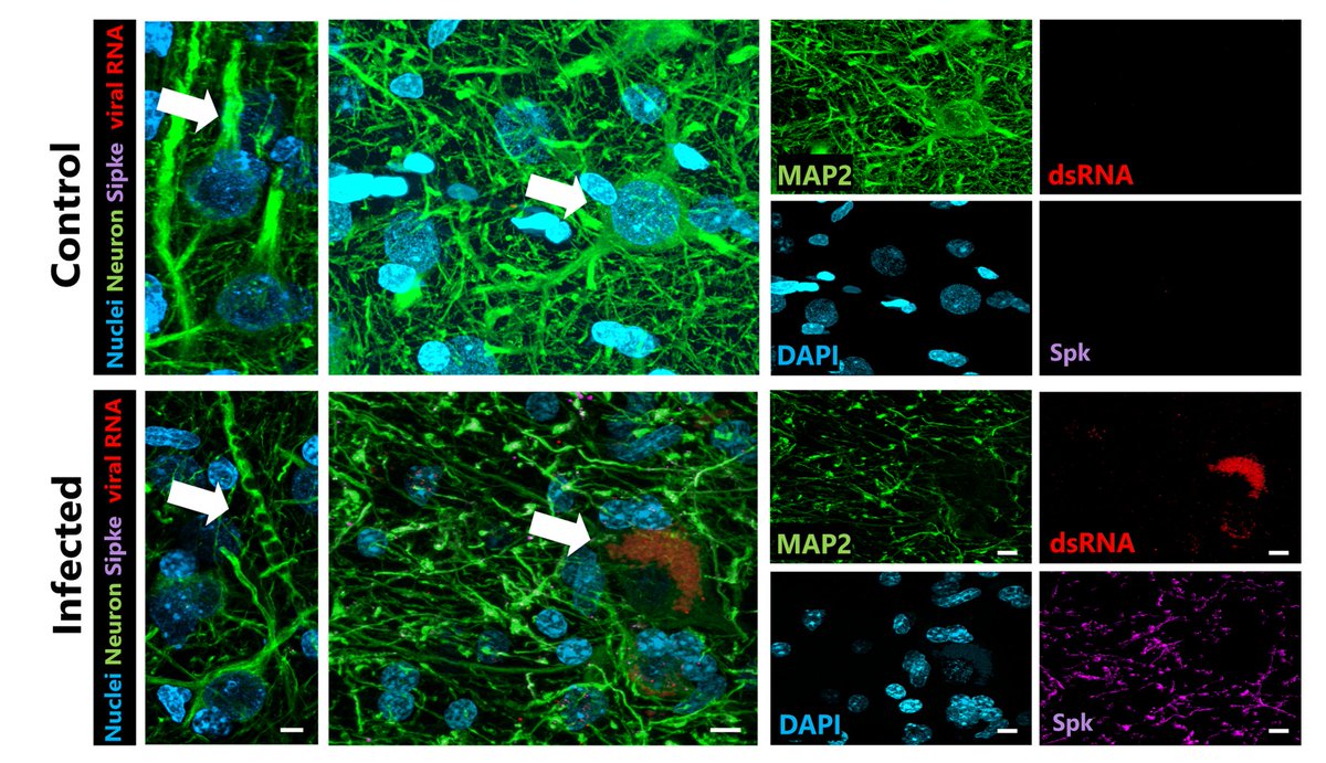 Scientists can work in a complementary way and find the same results. As a microscopist, I see neuronal proteins “disappearing” from the brain in the presence of #SARSCoV2 markers. Other scientists are detecting fragments of these proteins in the blood.