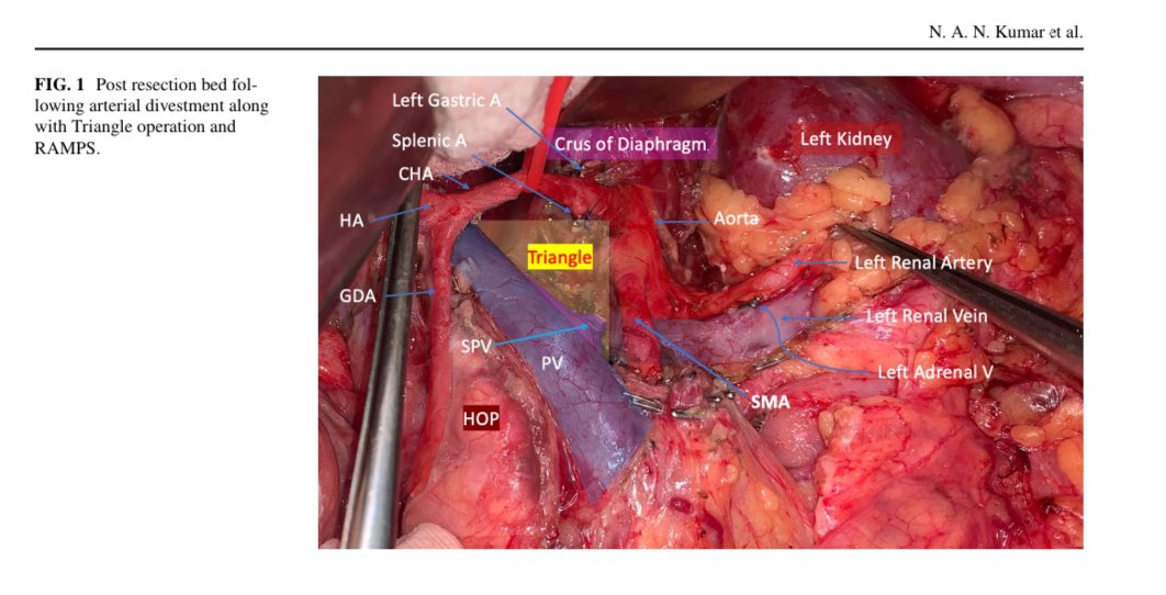 Periarterial and Subadventitial dissection + Triangle operation and RAMPS for locally advanced pancreatic cancer 
Watch surgical video at youtu.be/oOst_9KzyVg?fe…

<a href="/Shrikhande_SV/">Shailesh V. Shrikhande</a> <a href="/Manishbhandare4/">Manish S Bhandare</a> <a href="/NawazUsmanDr/">Nawaz</a> <a href="/docswapnil01/">Swapnil Patel</a> <a href="/OncoShravan/">Shravan Sharad Nadkarni</a> <a href="/sugoor_pavan/">Pavan Sugoor</a>