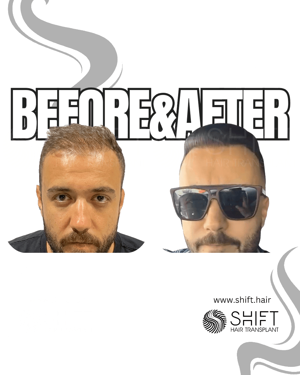 Before and after hair densification with hair transplant in Istanbul with SHIFT Hair in Turkey

#hairtransplant #hairtransplantresult #hairtransplantbeforeafter #shifthairturkey #hairtransplantturkey #hairtransplantistanbul