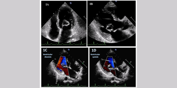 #ImageoftheWeek This #quiz was submitted by Vijay Soorampally et al. from the Trilife Hospital, Bengaluru, 🇮🇳 ☑️ shorturl.at/emBCS An asymptomatic middle-aged antenatal mother presents for screening echocardiography. What is the most likely diagnosis? 🤔 @EACVIPresident