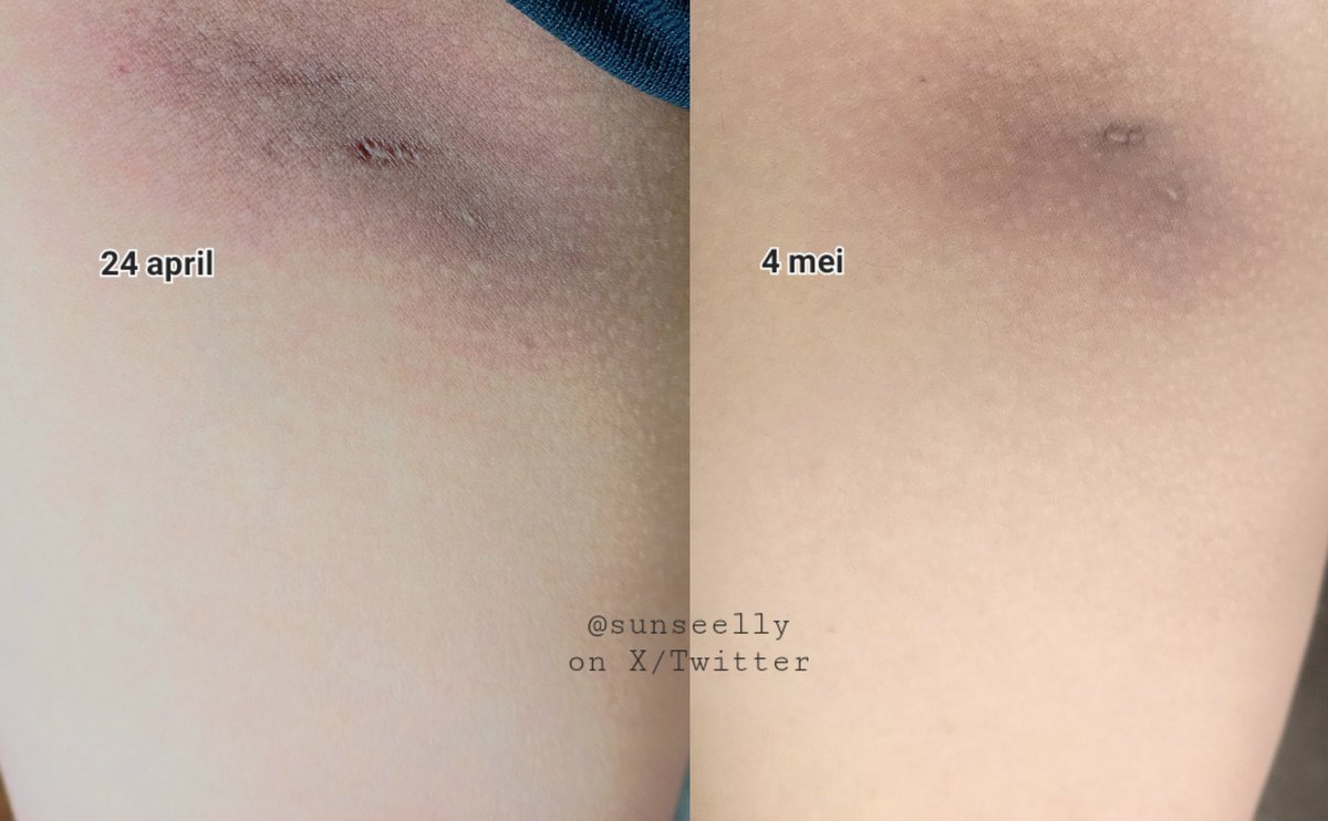 sunseelly's tweet image. Awalnya pas nyoba produk ini nggak berharap apa2, karna bekas luka abses memang agak susah ilang, apalagi hitam dan bertekstur :(

TAPI LIAT!!!😭🫶🏻