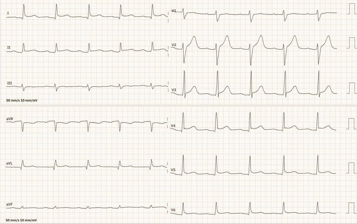 34 yo man, chest pain for several hours; what is the most likely diagnosis? 50 mm/s!!