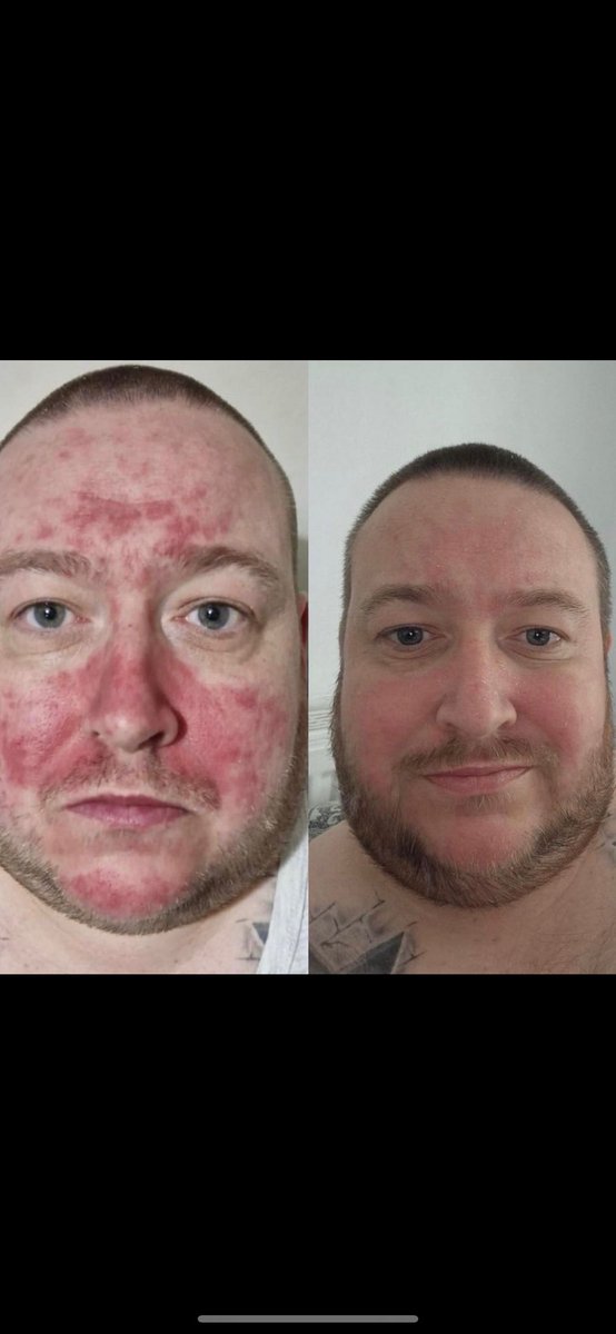 I’m not having that Ben,  I loved your before and after mate I’ve showed a lot of people 🙏🏻 DM me your address and I’ll sort you a Free psoriasis cream from @supreme_cbd 👊🏻👊🏻