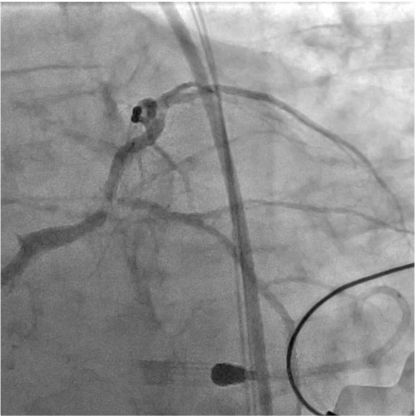 nicolasamabile's tweet photo. 77 y-o man, NSTEMI with hemodynamics instability Coronary angiography : occluded RCA + severe distal LM /LAD/ Cx lesion
Impella implantation + LAD &amp; Cx predilation with 2.0 semi compliant balloon
What are the next steps ? https://t.co/DdL66oCSa8