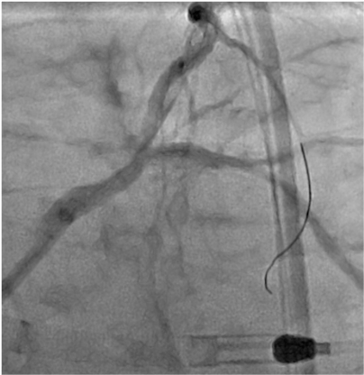 77 y-o man, NSTEMI with hemodynamics instability Coronary angiography : occluded RCA + severe distal LM /LAD/ Cx lesion Impella implantation + LAD & Cx predilation with 2.0 semi compliant balloon What are the next steps ?