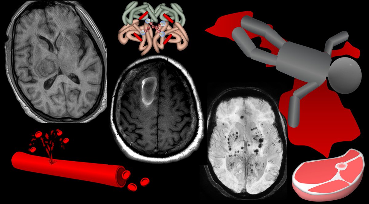 1/Asking “How old are you?” can be dicey—both in real life &amp; on MRI! 

Do you know how to tell the age of blood on MRI?

Here’s a thread on how to date blood on MRI! 

After reading this, when you see a hemorrhage, your guess on its age will always be in the right vein!