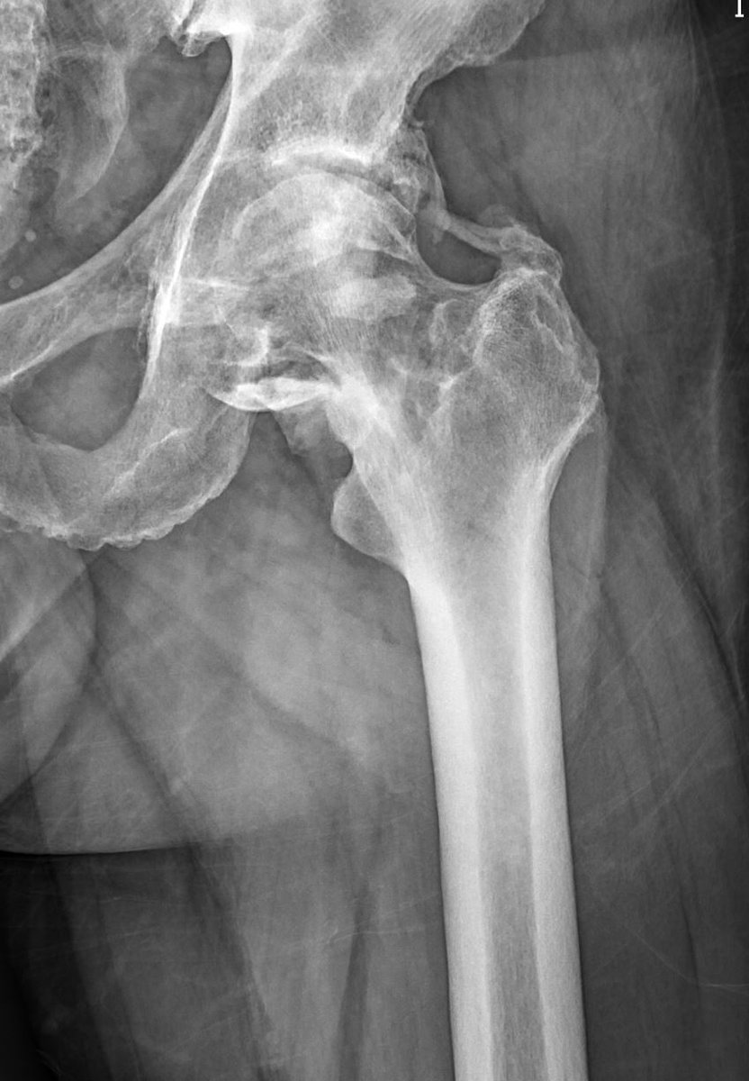 8/5/2024. 🟢 After years of a prolonged stay in the ICU, here are the X-ray results for the left hip. ❌ What are the findings? What´s your diagnosis? Stay tuned for comments and diagnosis! #MSK #traumatwitter