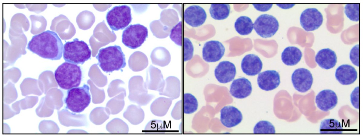 🌟#notablepaper on the Topic of Haematological Disorders 📚T-Cell Prolymphocytic Leukemia: Diagnosis, Pathogenesis, and Treatment 🔗mdpi.com/2410310 👨‍🔬By Prof. Ryan Wilcox et al @MDPIOpenAccess @MDPIBiologySubj #HaematologicalDisorders #leukemia #TCL1A #Tcellreceptor