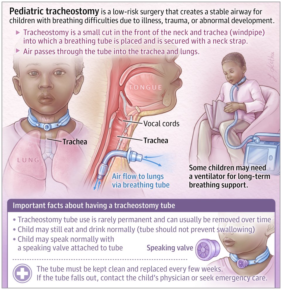 A tracheostomy is a surgical opening into the trachea or windpipe. This Patient Page discusses what parents can expect and answers some common questions if they are considering a tracheostomy for their child. ja.ma/43Xr9Jv