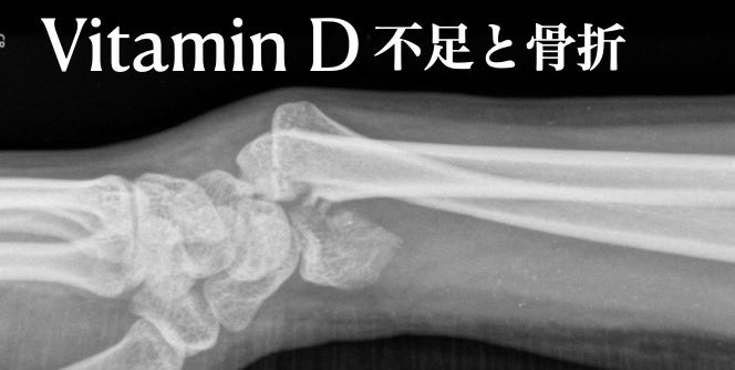 ビタミンD不足と橈骨骨折 橈骨とは前腕の親指側にある骨で、高齢者が転倒し、手をついた際によく起きる骨折が、橈骨遠位端骨折、またの名をコールス骨折と呼びます。 📝drmitsuo.com/2024/05/08/vit…