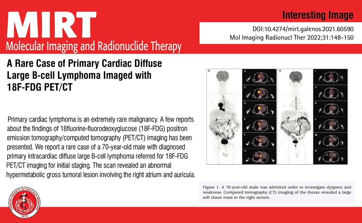 A Rare Case of Primary Cardiac Diffuse Large B-cell Lymphoma Imaged with 18F-FDG PET/CT

You can see the free full text of the research by Seval Erhamamcı et al.

Link : cms.tsnmjournals.org/Uploads/Articl…

#Primarycardiac #tumordiffuse #large #Bcell #lymphoma