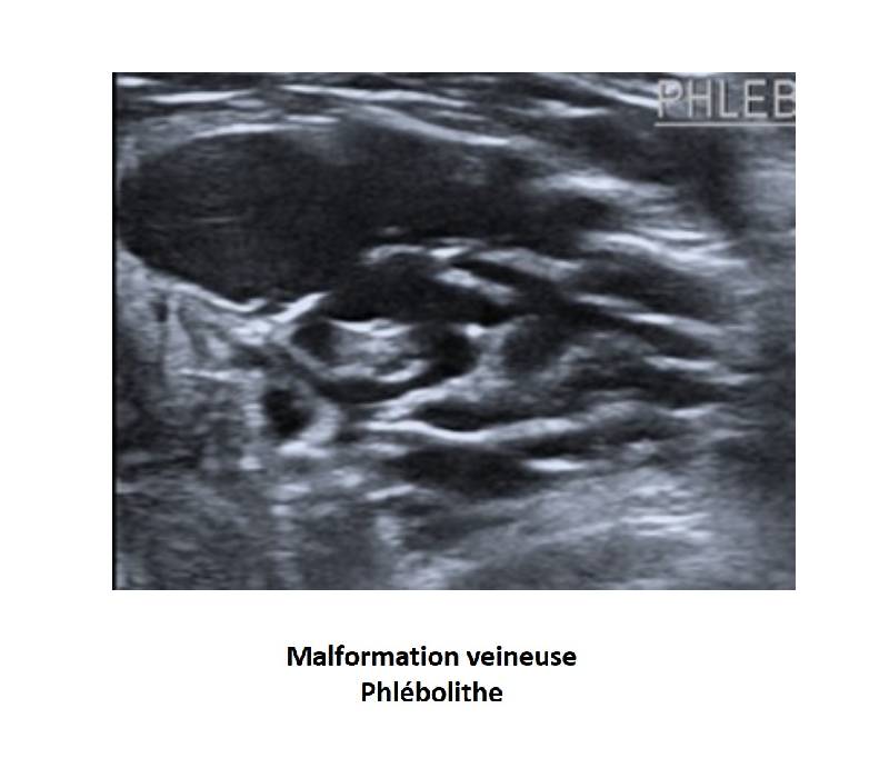 AOD et malformations veineuses medvasc.info/archives-blog/… @MiikkaVikkula @LaurenceBoon4 @HermansCedric @UCLouvain_be @vascern @VASCAPA @deDuveInstitute @alebura @AboyansV @AntaklyY @ALymphoedeme @AllianceMR @szuily @zudenstein @AdrianZidaritz @Aaron_Iding @ellto38 @EricBillyFR