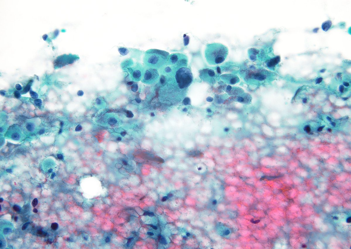 NOT a reason to call this thyroid FNA “AUS-nuclear”, this type of isolated anisonucleosis (in an oncocyte in this field) is common in benign “follicular nodular disease (adenomatoid nodule)”. Combination of oncocytes and abundant colloid is always a reassuring benign finding.