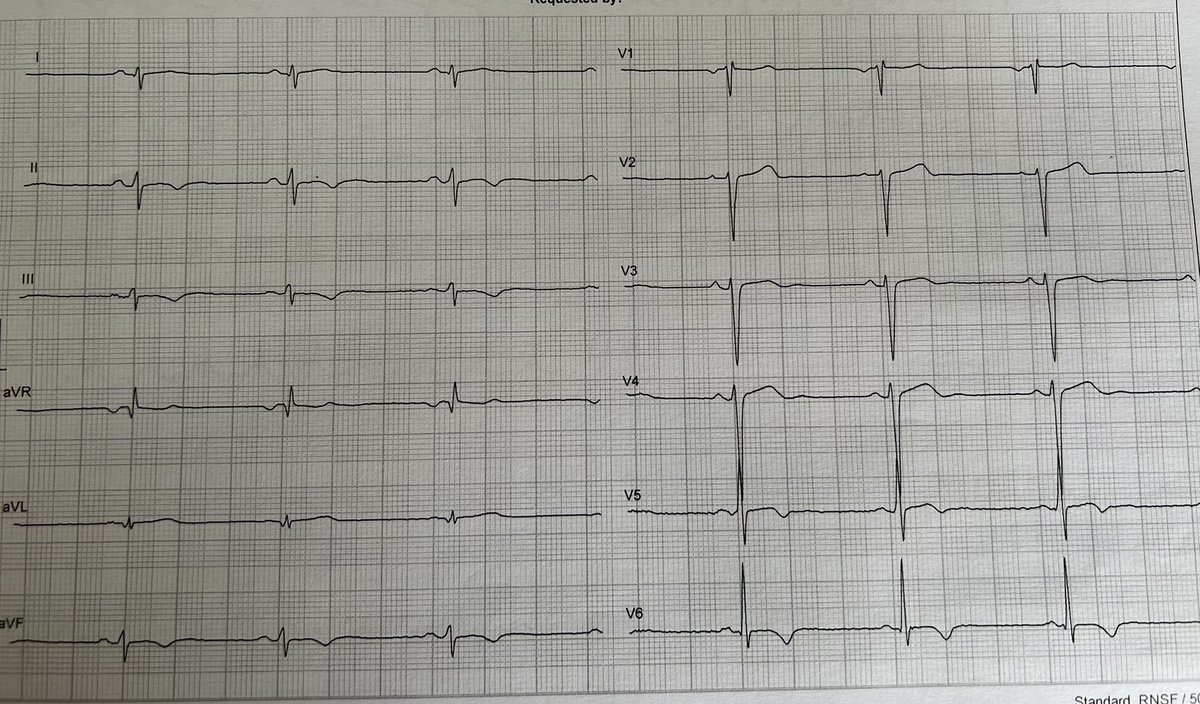 World class endurance athlete with this ECG and echo ecc. LVH; “normalisation” of TWI during exercise. Thoughts: ⬇️