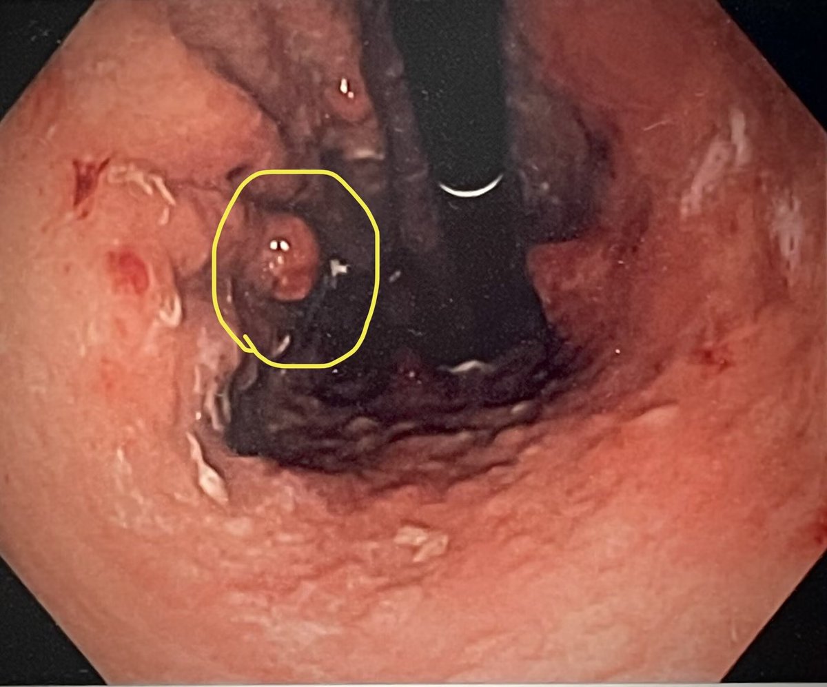 Stomach polypoid lesions

A 55-year old female patient was found to have hypergastrinemia

On EGD you found the following polypoid lesion. Biopsy showed carcinoid

What type of carcinoid is this?

A. Type 1
B. Type 2
C. Type 3
D. None of the above

Reply below for the answer