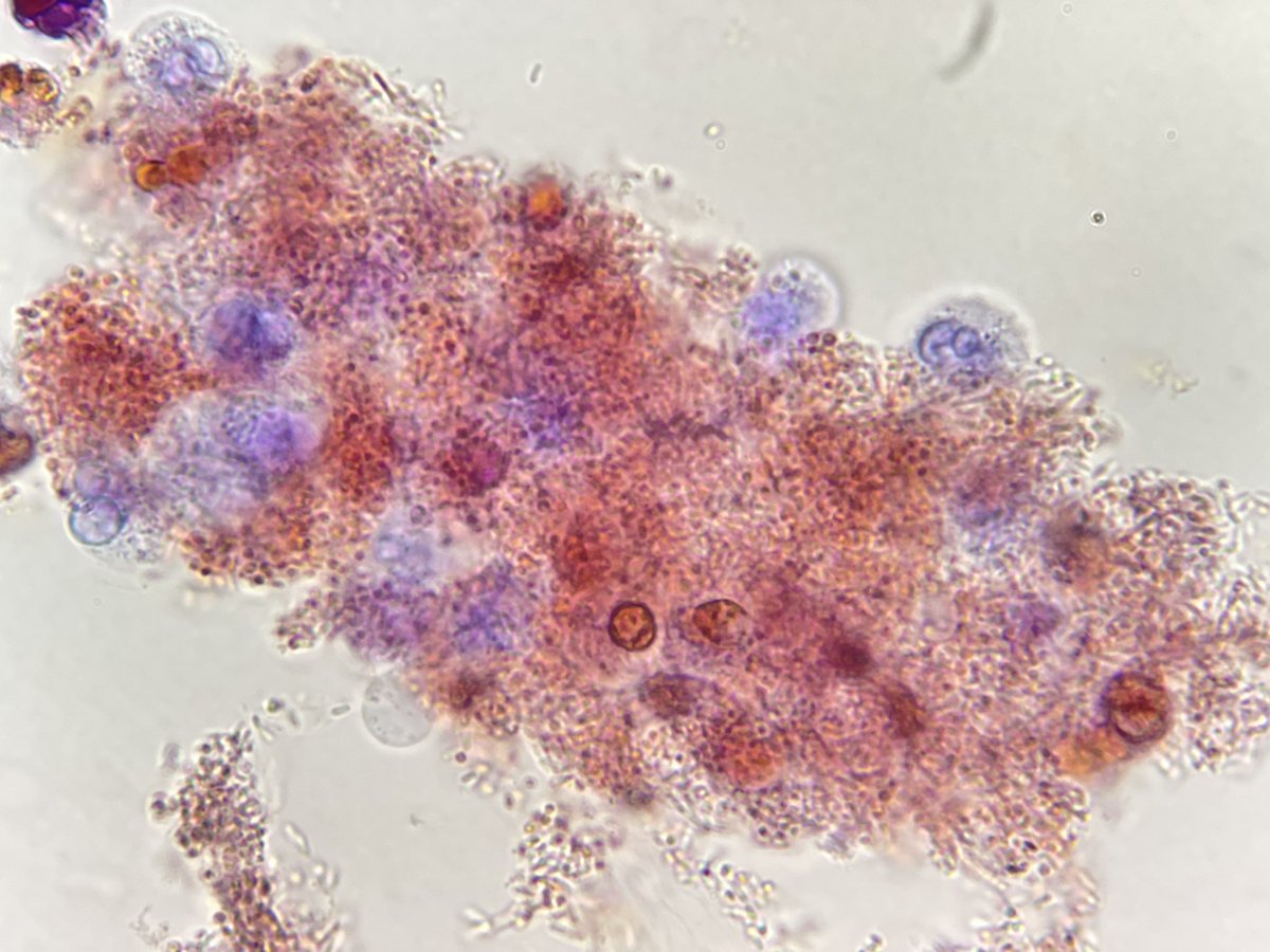 Cilindros bacterianos teñidos con Sternheimer-Malbin. Patognomonicos de pielonefritis.