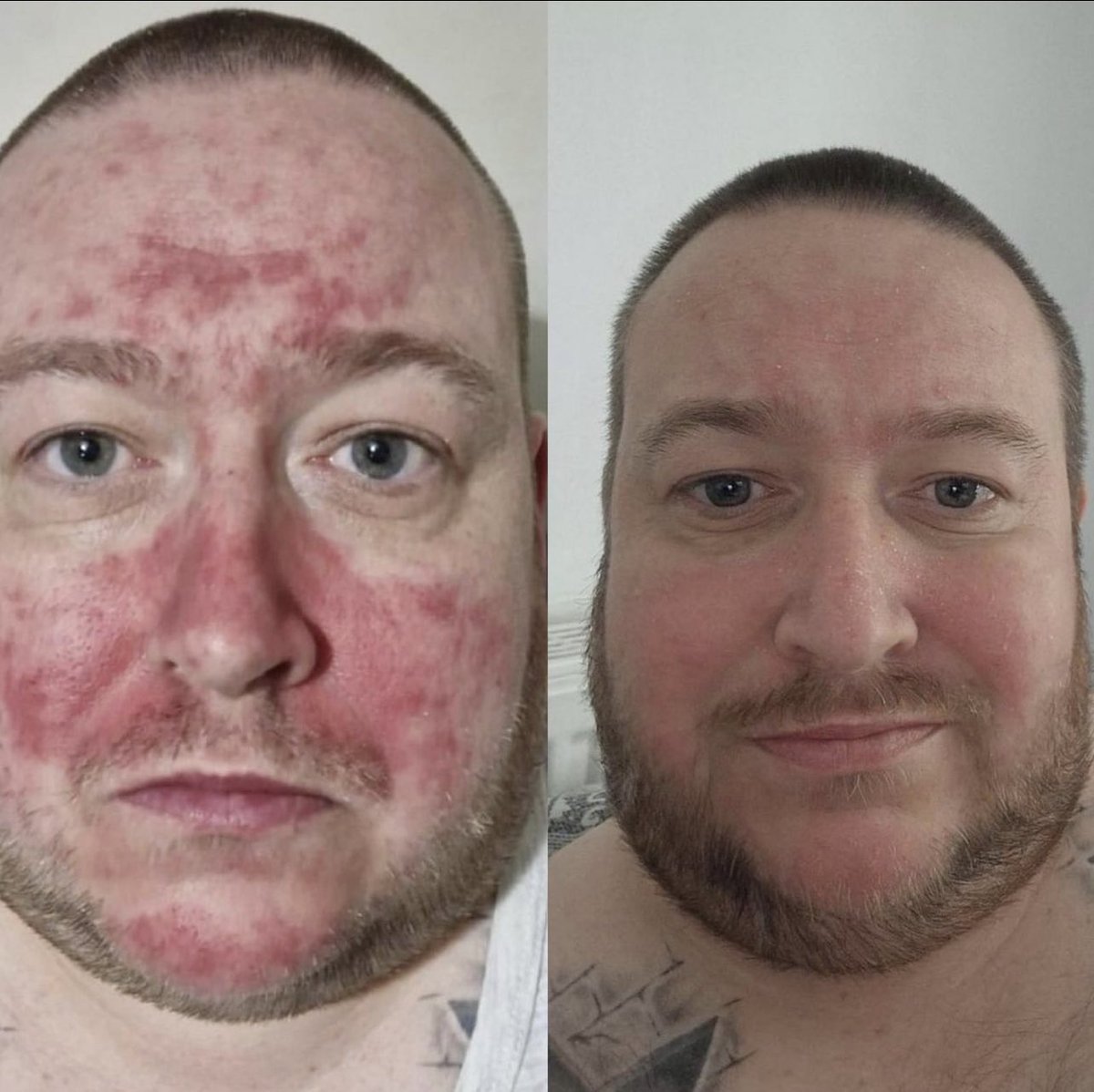 @gazmax01 @supreme_cbd @afowler06 Honestly, mate, it's amazing it's the psoriasis cream from @supreme_cbd look at my before and after pic