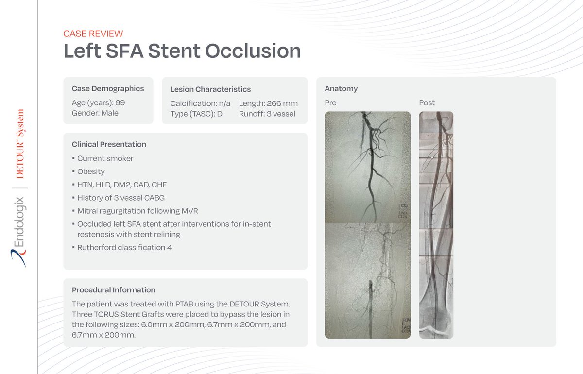 Who is the PTAB patient? They vary based on factors like this case: left SFA stent occlusion treated with the DETOUR System. What's your treatment plan for similar cases? Share below! p.allego.com/_WO7E6KDY6XDVi_ US Rx Only. ISI: endologix.com/import-safety-…