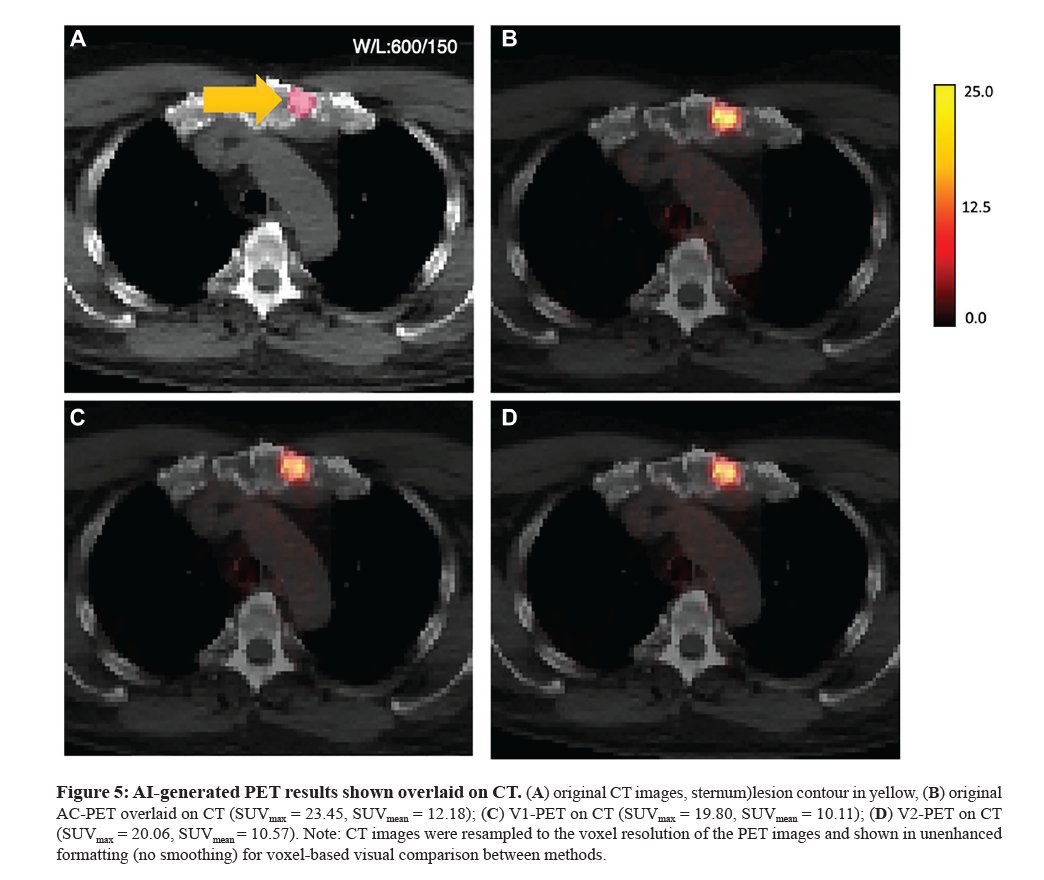 📢I am happy to share our new publication 'Deep learning-based whole-body PSMA PET/CT attenuation correction utilizing Pix-2-Pix GAN' oncotarget.com/article/28583/… 👍Congratulations to Kevin Ma, @DrSHarmon and our Team🎉 #ArtificialIntelligence #GenerativeAI #ProstateCancer #AI