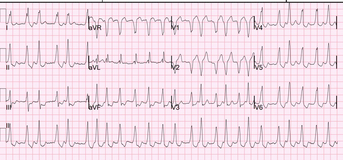 A young man with palpitations. hqmeded-ecg.blogspot.com/2024/05/a-youn…