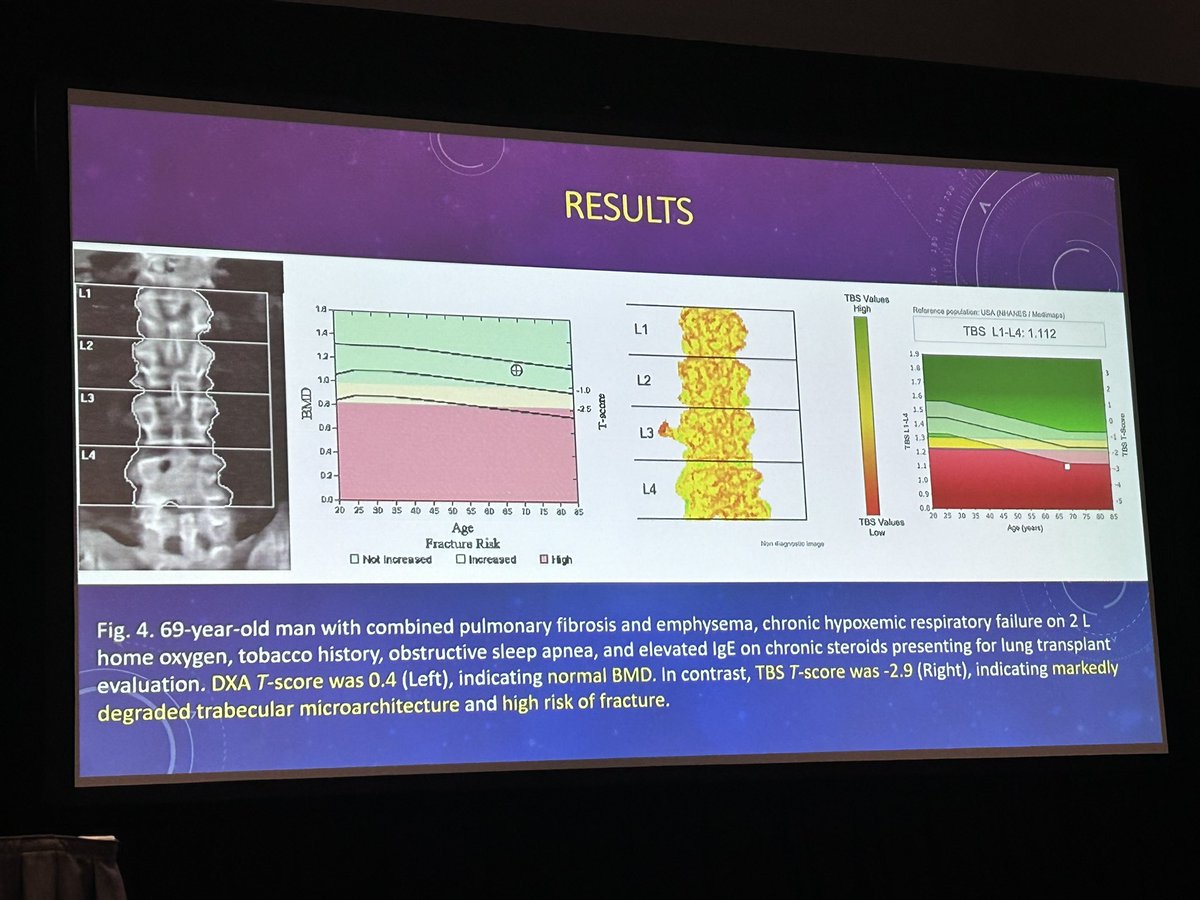 Excellent “Emerging Research” presentation by @AlainShermanMD, one of our @MontefioreRAD amazing R1s, at #ARRS2024 on total bone score TBS utility in lung transplant patients. @ARRS_Radiology @MontefioreNYC @JudyYeeMD @JudahBurnsMD