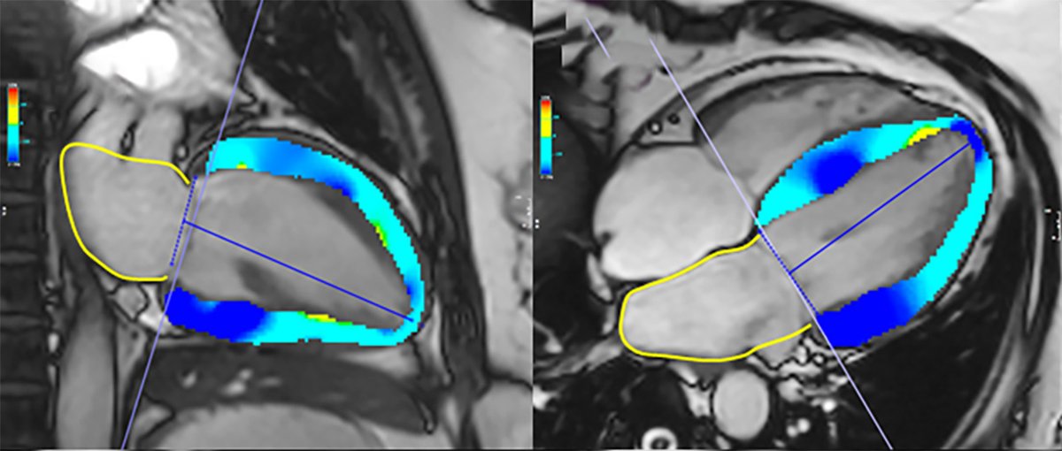 NEW PUBLICATION 📜Heart Failure with Normal Natriuretic Peptide Levels and Preserved Ejection Fraction 🔹Prospective study evaluating a clearly defined cohort of individuals with heart failure with preserved ejection fraction using CMR ⛓️doi.org/10.1148/ryct.2…