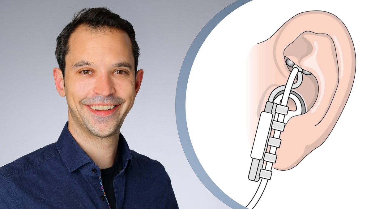 Behandlung von #Depressionen durch das Ohr: Weltweit erstmals wurde an der #Uniklinik #Köln eine transkutane aurikulare Stimulation des Vagusnervs (taVNS) bei einer Jugendlichen mit Depressionen durchgeführt. Mehr lesen: uk-koeln.de/uniklinik-koel… @koeniglab