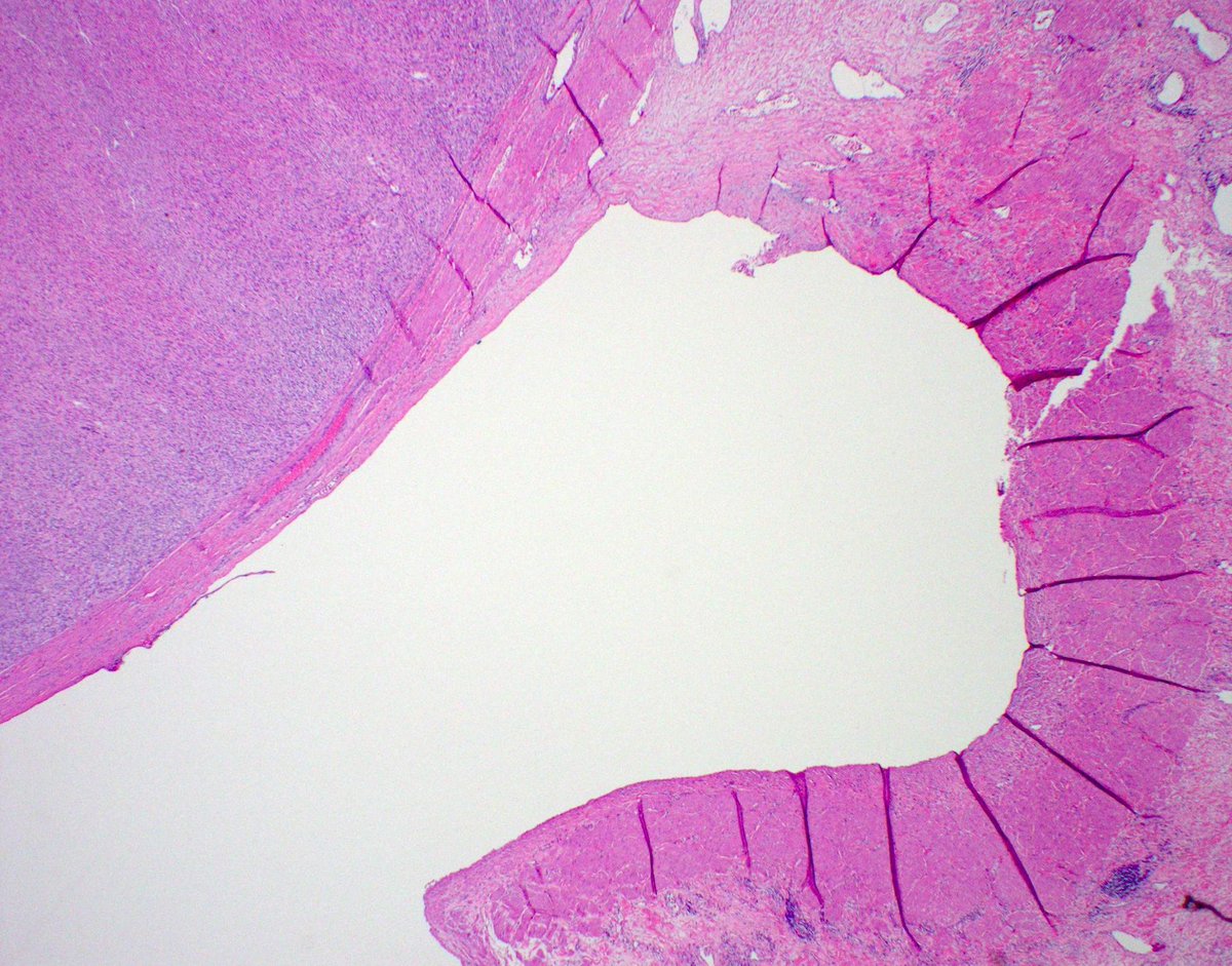 60 yo M with large mass at renal hilum. Your diagnosis? Click here for immunostain findings & answer: kikoxp.com/posts/7966. #BSTpath #pathologists #pathology #pathTwitter #GUpath