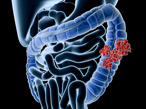 . @GeneoscopyCo RNA-Based #ColorectalCancer Test Approved by @US_FDA. Learn more: ow.ly/rKzT50RzMXU