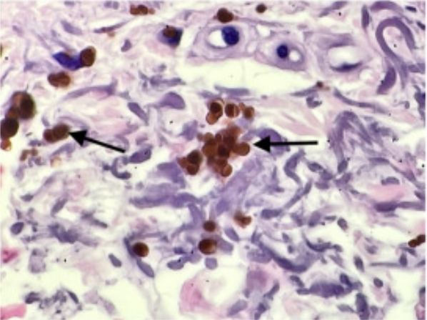 Christine J. Ko, MD (@christinejkomd) on Twitter photo Cool case! #diagnosis? <a href="/yalederm/">Yale Dermatology</a> GR had a case of this today! both arms affected, photodistributed; #dermpath "red-orange, regularly spherical, of overall smaller dimension, and negative for Perls iron stain" jaadcasereports.org/article/S2352-… <a href="/JAADjournals/">JAAD Journals</a> #dermatology #pathology Cool case! #diagnosis? <a href="/yalederm/">Yale Dermatology</a> GR had a case of this today! both arms affected, photodistributed; #dermpath "red-orange, regularly spherical, of overall smaller dimension, and negative for Perls iron stain" jaadcasereports.org/article/S2352-… <a href="/JAADjournals/">JAAD Journals</a> #dermatology #pathology