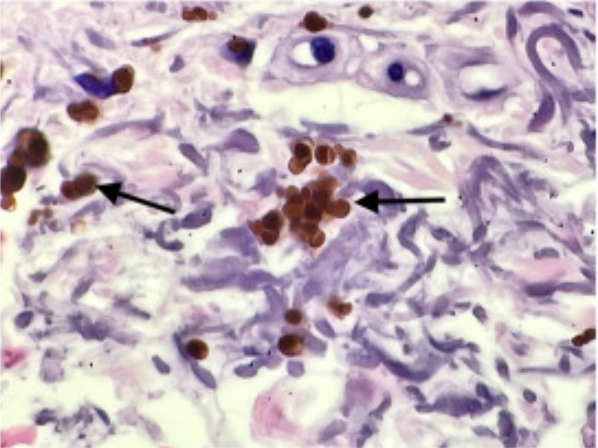 Cool case!  #diagnosis?  @yalederm GR had a case of this today! both arms affected, photodistributed; #dermpath 'red-orange, regularly spherical, of overall smaller dimension, and negative for Perls iron stain' jaadcasereports.org/article/S2352-… @JAADjournals #dermatology #pathology