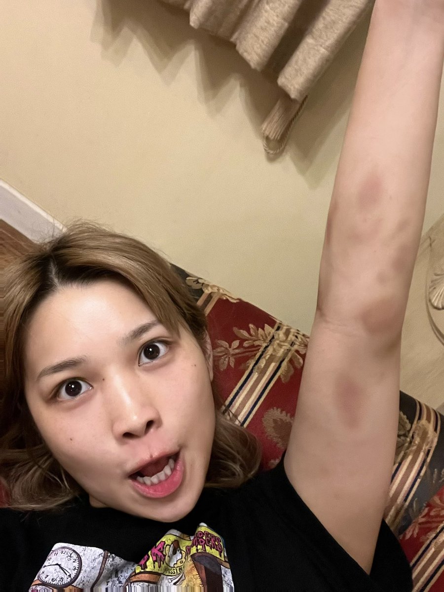 Anna Hirai, who plays Mayu Iwatani in the movie 'Runaway Wrestler', shows all the bruises and scars she got during wrestling practice.

#STARDOM #家出レスラー #平井杏奈