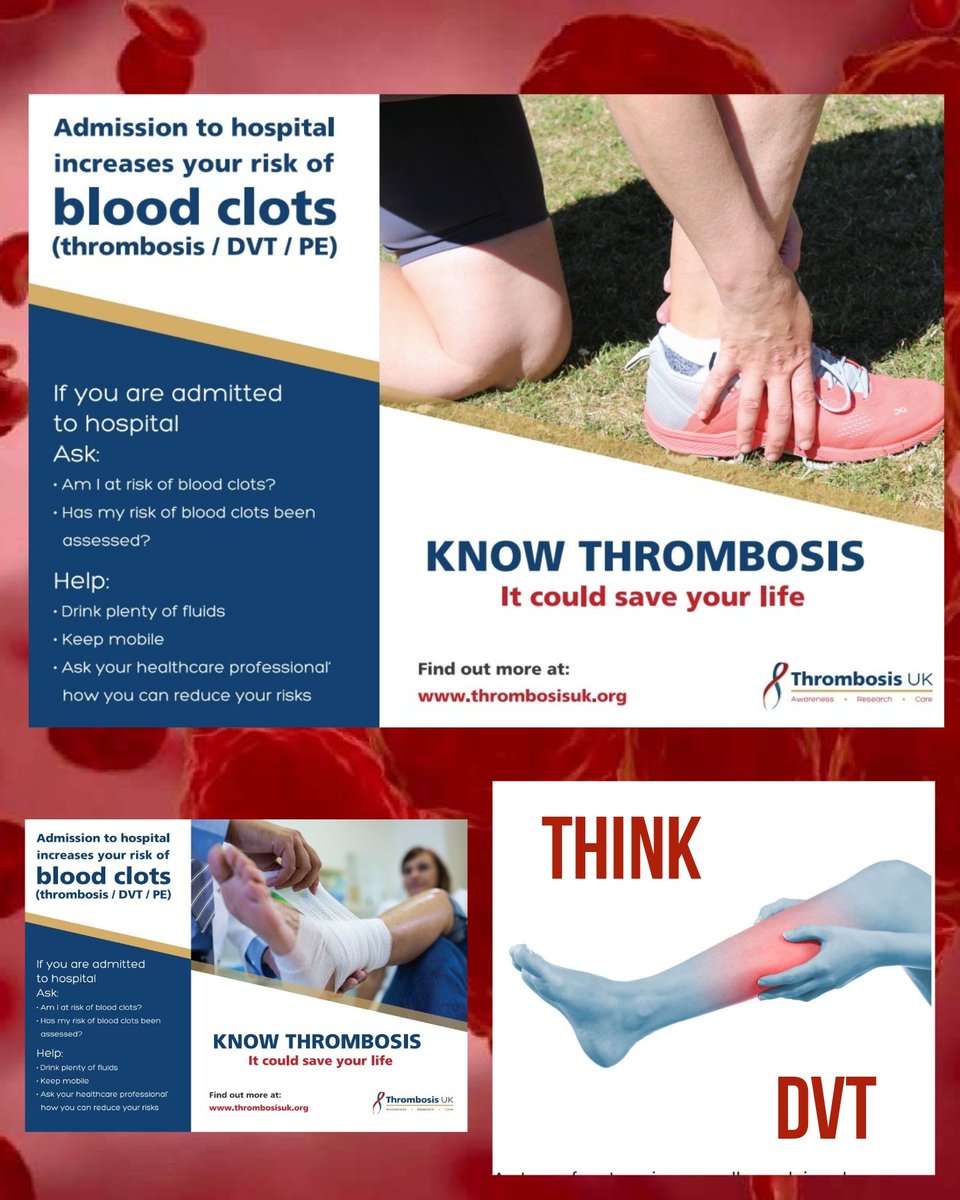You can get a DVT from a kick, tackle, sprain or even a smaller trauma. An injury can damage the blood vessel &amp; block the blood flow, resulting in DVT. Whether your chosen sport is high contact or low contact, injuries and DVTs as a result of those injuries can occur.

#NTW24