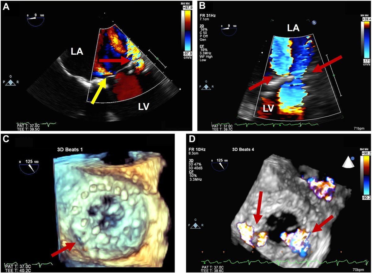 Acoustic shadowing may make detection of significant regurgitation difficult, particularly in the presence of multiple prostheses. This case shows the limitations of 2D TTE and color-flow Doppler evaluation in the presence of mitral and aortic prostheses. bit.ly/4b65yS4