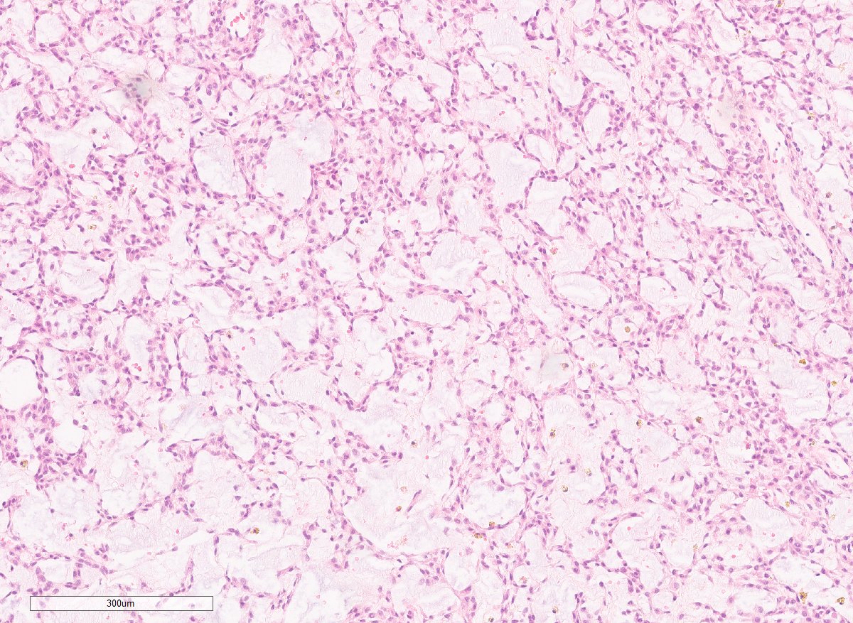 Extraskeletal Myxoid Chondrosarcoma.

🔬
Multinodular pools of uniform, interconnected tumor cells w/eosinophilic/vacuolated cytoplasm, in cords/clusters/trabeculae.

Abundant hypovascular myxoid/chondromyxoid matrix.

Usually lacks discernible cartilaginous histology.

#BSTpath
