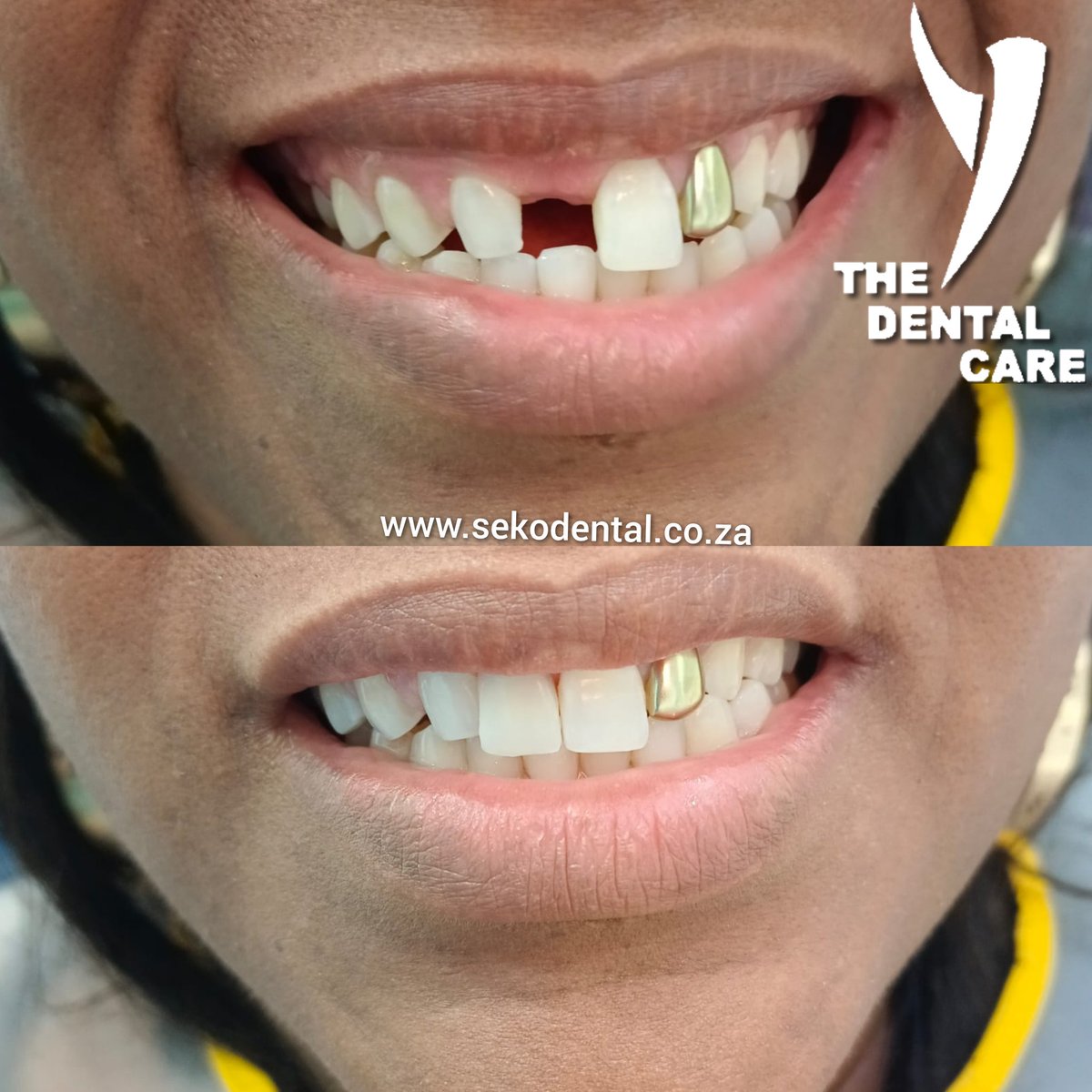 'Restore your smile and confidence by replacing missing teeth! Whether through dental implants or bridges, modern dentistry offers effective solutions for a brighter, happier smile. #DentalHealth #SmileRestoration'sekodental.co.za