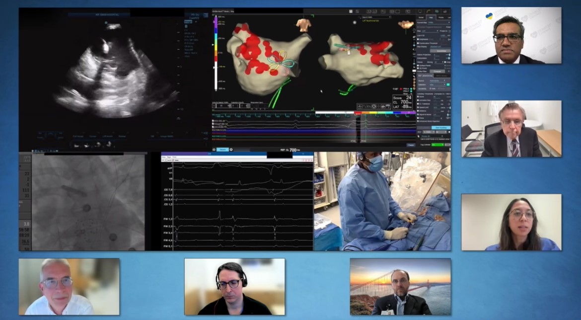 #EPeeps On-Demand @ConnectEp Live Case Session. PFA for AF with Electroanatomic Mapping Guidance by Srini Dukkipati from @MountSinaiHeart featuring @VivekReddyMD Frank Marchlinski @Mel_Gunawardene, @Dr_Santangeli @NeuzilPetr Christopher Woods Access @ epconnect.live/pfalivecase