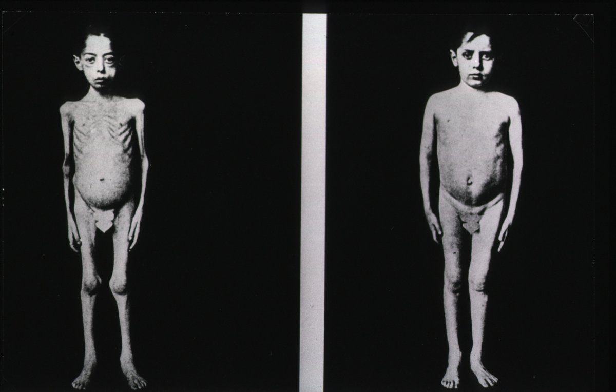 Insulin drives obesity independent of calories. Views of a diabetic child consuming the same number of calories. The right image is following treatment with insulin for eight weeks. Verso: WHO/18198. EURO. Diabetes. SM 5-1979
