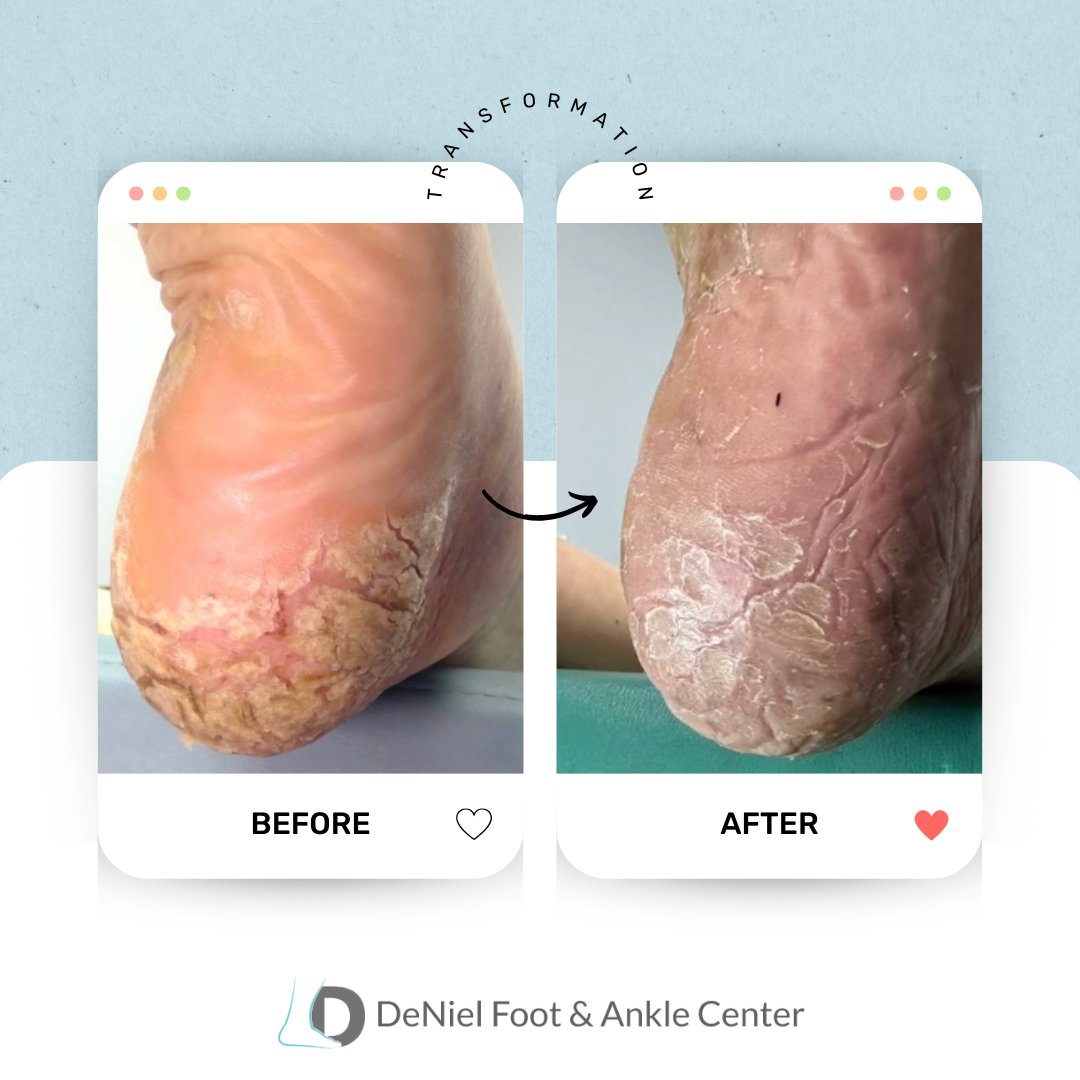 Dry, cracked heels pose particular concern, especially for individuals managing diabetes. Entrust your foot health to a podiatrist who specializes in diabetic foot care.

#houstonfootdoctor #texasfootdoctor⁠ #houstonpodiatrist #texaspodiatrist #houstontx #houstonhealth #htx