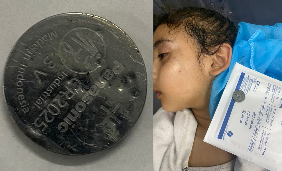 Ummanlı doktorun dediğine göre bu saat pilini 5 yaşındaki Gazzeli çocuğun midesinden çıkarmış.

Gazze'de bu ameliyatı yapacak doktor bulunmuyor fakat bu Ummanlı doktor tüm saldırılara rağmen Gazze'yi terk etmeyi reddetmiş.

- Çocuk pili açlıktan yemiş..